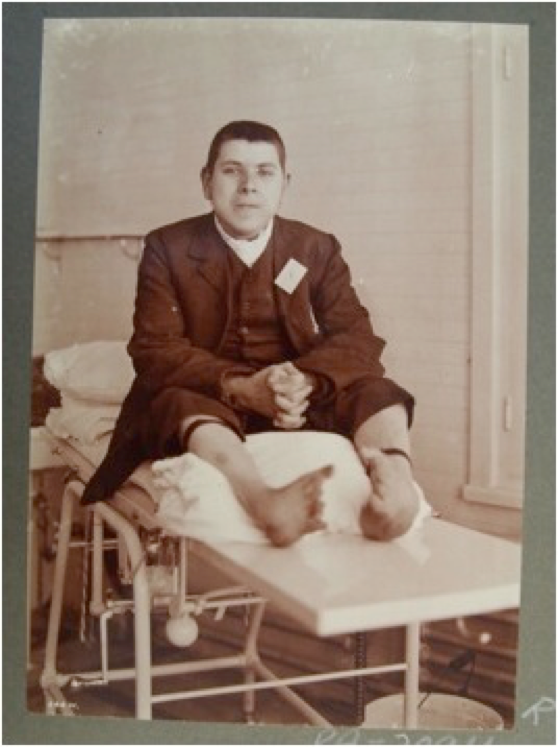This image depicts a young, light-skinned person sitting upright on a medical gurney with legs stretched out in front, wearing a suit with a vest, a white shirt, and no tie. The pant legs are pulled up, and the subject's feet are bare-the feet are in the foreground of the photograph, resting on a pillow, slightly blurred. The toes seem to point towards one another and the feet are misshapen. The subject has black bands around both calves, perhaps garters, suggesting that the socks and shoes have been removed. The subject has short-cropped hair and looks directly into the camera. A tag is pinned onto the lapel of the subject's jacket with the letter "X" written on it. If the subject used mobility aids, they are not in the frame.